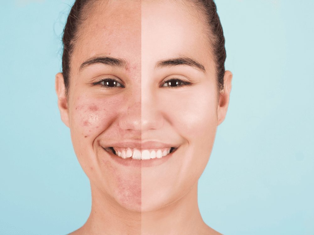 Acne Ingredient Checker Acne Ingredient Checker